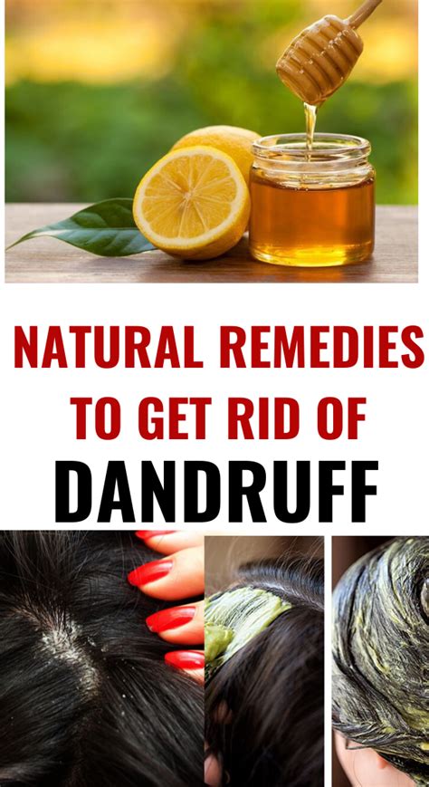 How To Get Rid Of Dandruff Naturally Permanently At Home | Trabeauli ...