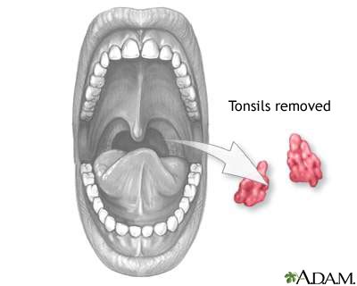 Tonsillectomy: MedlinePlus Medical Encyclopedia