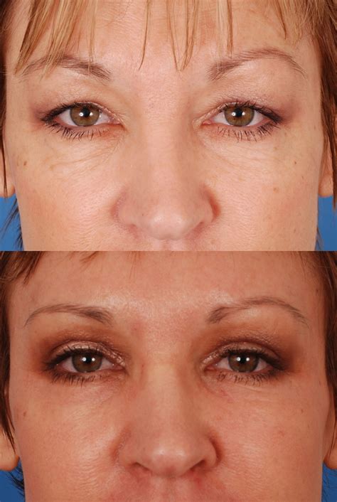 Eyelid Surgery Before & After Photos | Dr. Bassichis