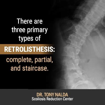 Retrolisthesis: Types, Symptoms, Causes, and Treatment