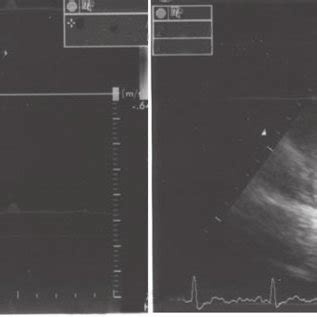 (a) Trans-thoracic echocardiography revealed tricuspid valve... | Download Scientific Diagram