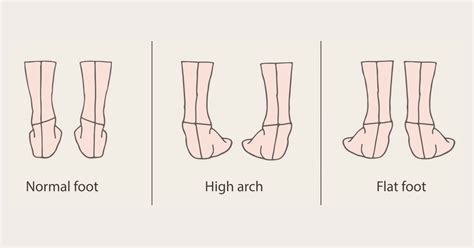 Treatments for Painful or Sore Foot Arches | Heel That Pain