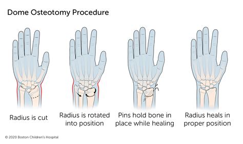 Madelungs Deformity | Boston Children's Hospital