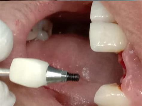 Dental Implant Case Studies | Smritiraj Dentistry