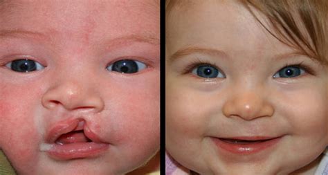 All the info about Cleft Lip and Cleft Palate Repair Surgery