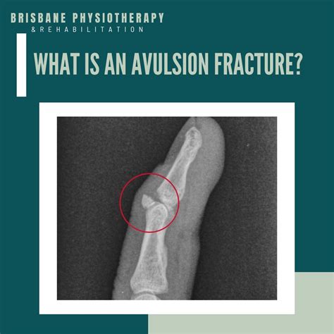 What is an Avulsion Fracture? - Brisbane Physiotherapy