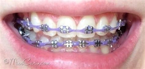 Power Chain Braces Colors : I'm supposed to be getting elastics and a ...