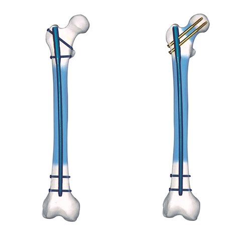 China Femur Interlocking Nail Reconstruction Intramedullary Nail - China Intramedullary Nail ...