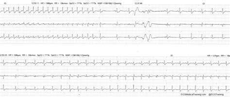 SVT, Adenosine, and Postural Modification to the Valsalva Maneuver (REVERT Trial) - ECG Medical ...