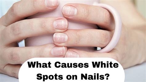 White Spots on Nails: Causes, Symptoms, and Treatment