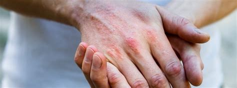 Things to know about psoriasis - Dallas Derm Center