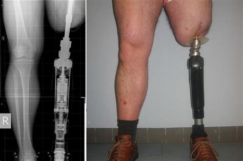 New prosthetics are ‘smart’ enough to adapt to their user