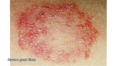 fungal infection rash - YouTube