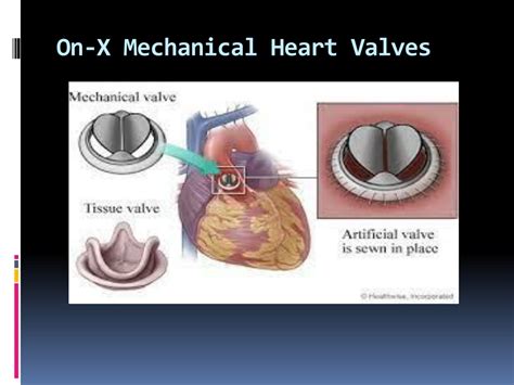 PPT - On-X Mechanical Heart Valves PowerPoint Presentation, free download - ID:10581713