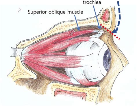 Sagittal view of extraocular muscles in right orbit. The range of... | Download Scientific Diagram