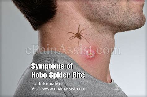 Symptoms of Hobo Spider Bite & It’s Treatment, Prognosis, Prevention | Hobo spider bite, Hobo ...