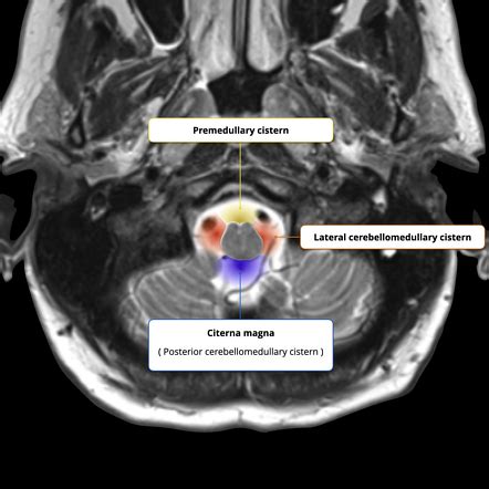 Cerebellomedullary cisterns (illustration) | Radiology Case | Radiopaedia.org