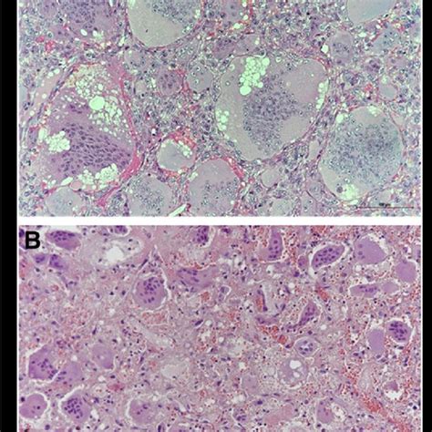 Case presentation. a Histology of the specimen excised in 2014 from ...