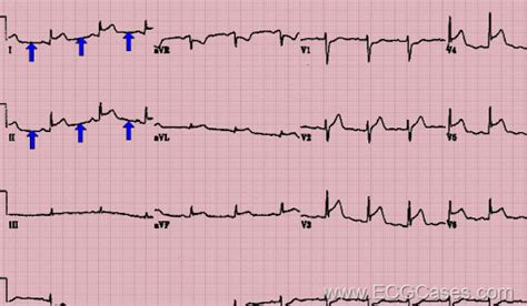 gw manis: Retrograde P Wave