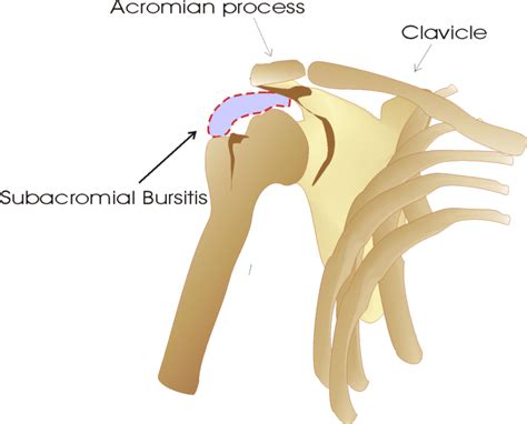 Mild Subacromial Bursitis