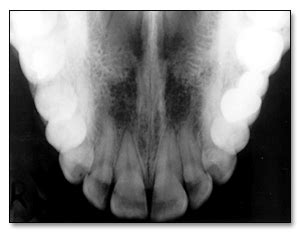 Dentistry and Medicine: Intraoral Radiographic Techniques (Intraoral ...