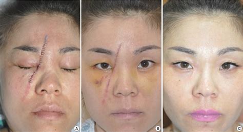 Figure 1 from Effects of Minimizing Scar Formation by Early Fractional CO2 Laser Resurfacing ...