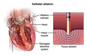 Which Ablation Procedure Radiofrequency or Cryoablation Is Best