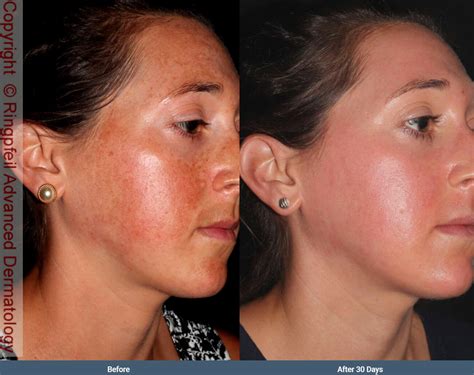 Melasma Hyperpigmentation Treatment, PA | Melasma Removal, Philadelphia