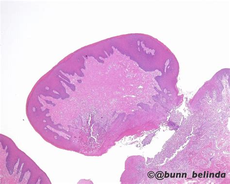 Irritation Fibroma Histology