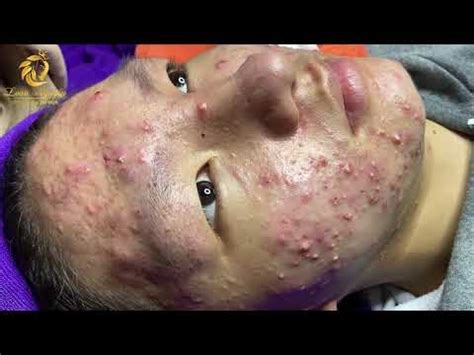 Loan Nguyen treats a very severe case of acne