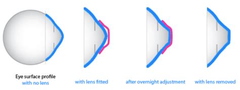 All About Ortho-K Lenses - Dr. Sam Dhaliwal & Associates