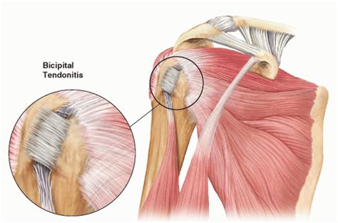 Ultrasound-Guided Injection Technique for Bicipital Tendonitis ...