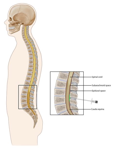 Lumbar Epidural Injection | Spinal Pain | Chronic Spine Pain | Pain Spa ...