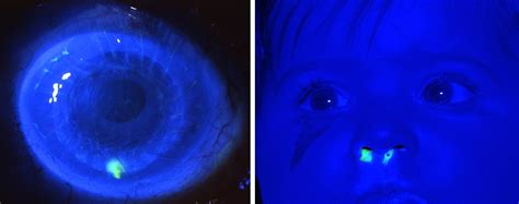 Fundamentals of Fluorescein | EYE-PIX