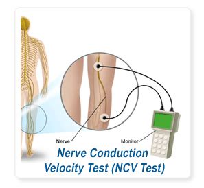 Nerve Conduction Velocity (NCV TEST) | Pucillo Family Practice PA