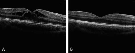 Canakinumab for Childhood Sight-threatening Refractory Uveitis: A Case Series | The Journal of ...