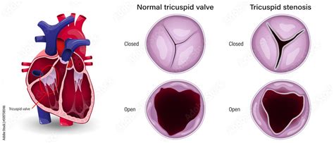 Valular heart disease. The difference of tricuspid stenosis and normal tricuspid valve. Stock ...