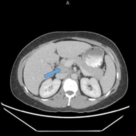 Abdominal computed tomography with an arrow pointing to the enlarged... | Download Scientific ...