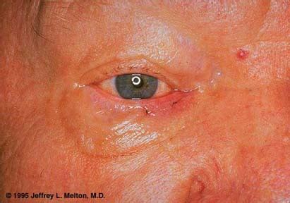 Nodular Basal Cell Carcinoma of the Eyelid