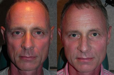 Sculptra Before and After – Adam Scheiner MD | Dr. Adam Scheiner