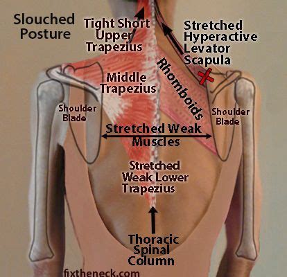 Effective Hip Flexor Stretch: Fix the Posture Pilates, Scoliosis Exercises, Piriformis Exercises ...