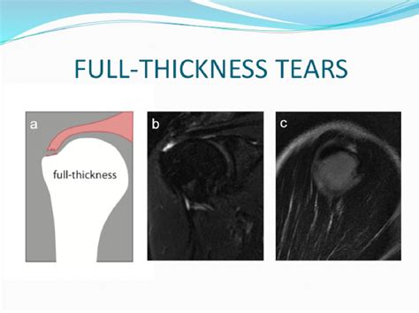 Tears at the rotator cuff footprints: imaging characteristic on MRI and ultrasound, evolutions ...