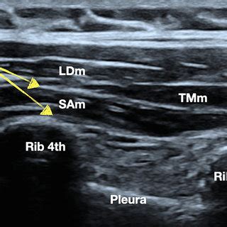 Ultrasound image of intercostal nerve block. ICm intercostal muscles... | Download Scientific ...