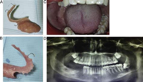 The adjustment of the Stent during the follow-up visit. A. A photograph... | Download Scientific ...