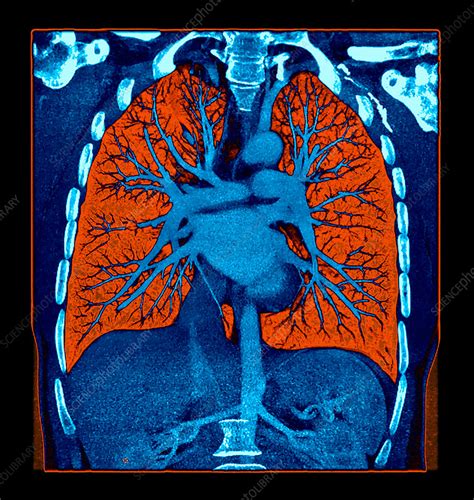 Enhanced CTA Chest - Stock Image - C043/0142 - Science Photo Library