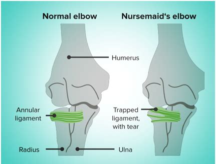 Pulled Elbow: All you need to know - Dr Ratnav Ratan