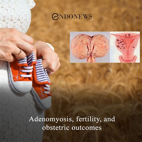 Adenomyosis, fertility, and obstetric outcomes | EndoNews