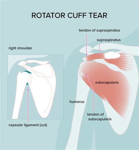 Rotator Cuff Injury: Treatments, Symptoms, and Diagnosis