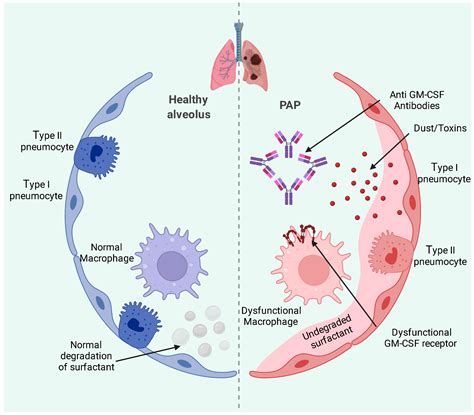 Medicina | Free Full-Text | Pulmonary Alveolar Proteinosis and ...