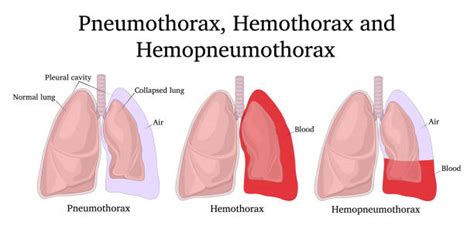 290+ Grafiken, lizenzfreie Vektorgrafiken und Clipart zu Pneumothorax - iStock